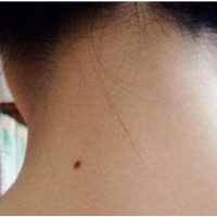 [面相]脖子后面有痣的人看过来，这些特征中了几个？